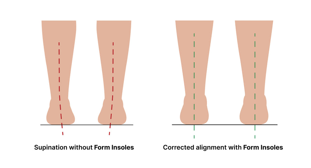 Supination – Form Insoles