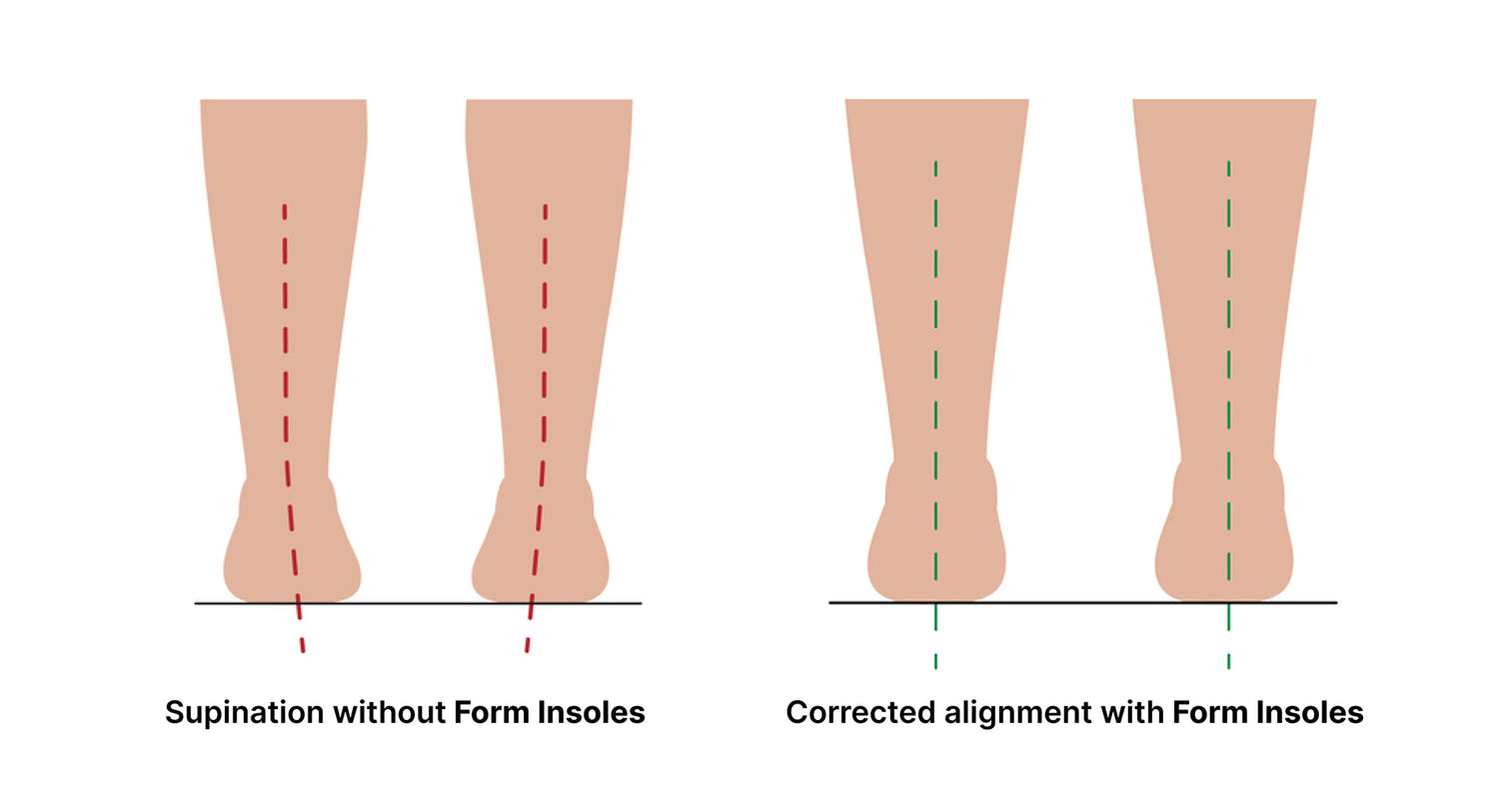 Supination – Form Insoles