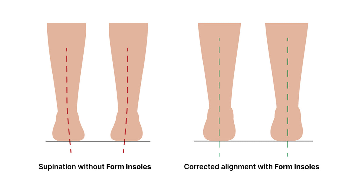 Understanding Supination & Foot Alignment – Form Insoles